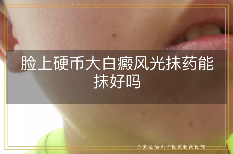 脸上硬币大白癜风光抹药能抹好吗