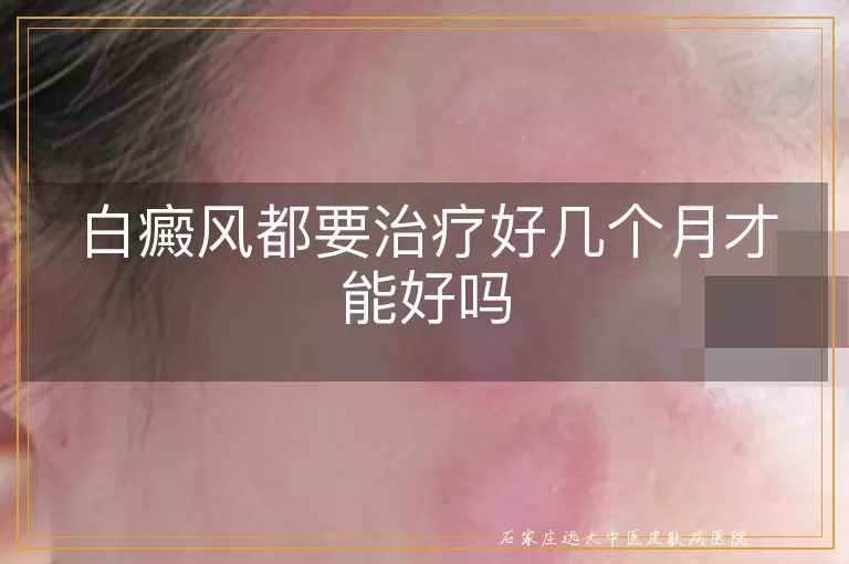 白癜风都要治疗好几个月才能好吗