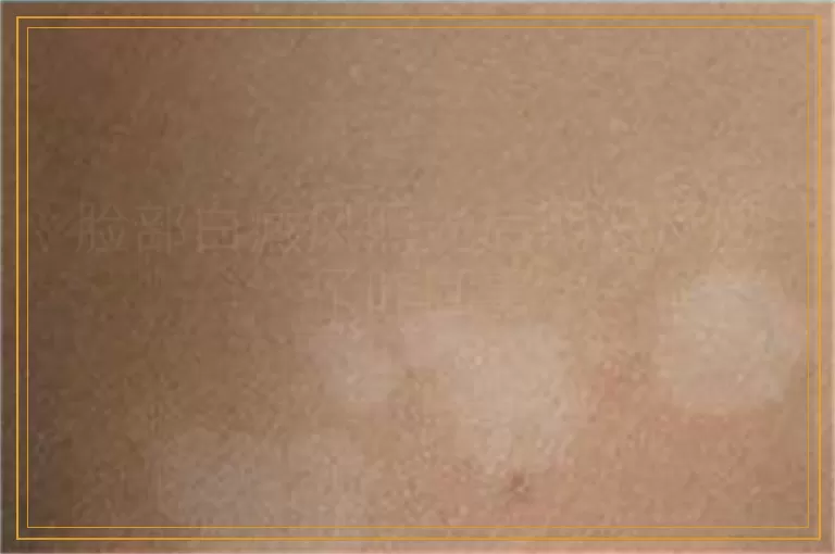 脸部白癜风照光后期没反应了咋回事