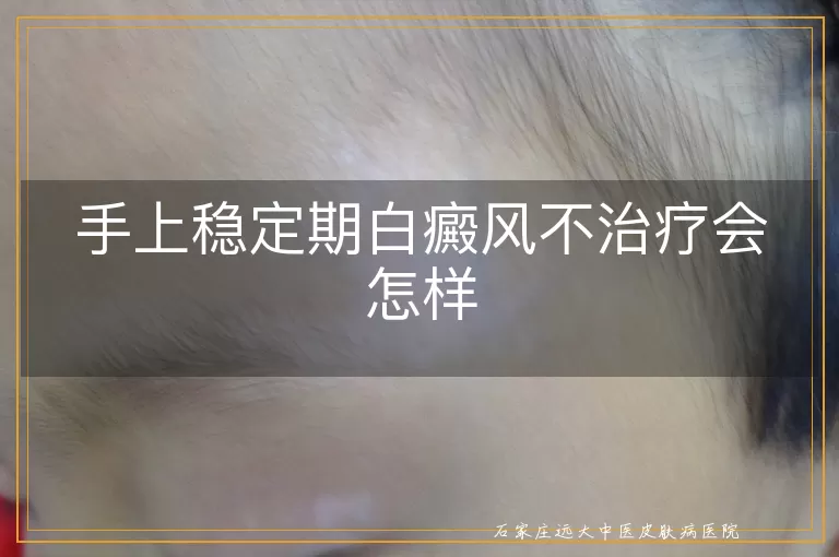手上稳定期白癜风不治疗会怎样