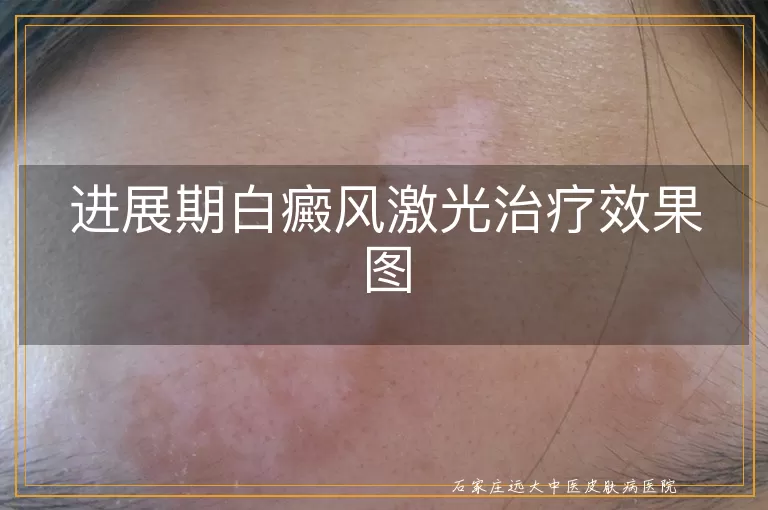 进展期白癜风激光治疗效果图
