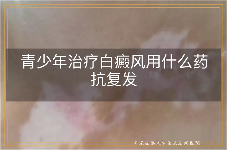 青少年治疗白癜风用什么药抗复发