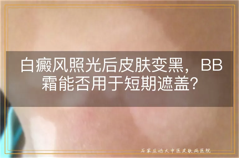 白癜风照光后皮肤变黑，BB霜能否用于短期遮盖？