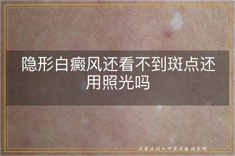 隐形白癜风还看不到斑点还用照光吗