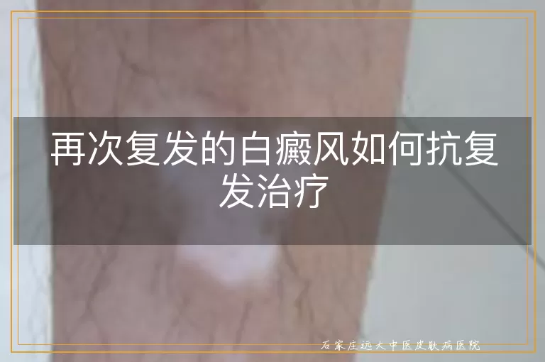 再次复发的白癜风如何抗复发治疗