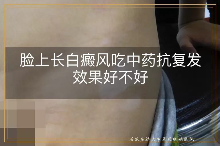 脸上长白癜风吃中药抗复发效果好不好