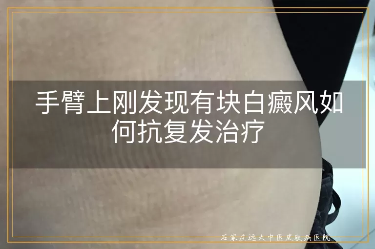 手臂上刚发现有块白癜风如何抗复发治疗