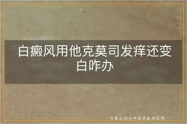 白癜风用他克莫司发痒还变白咋办
