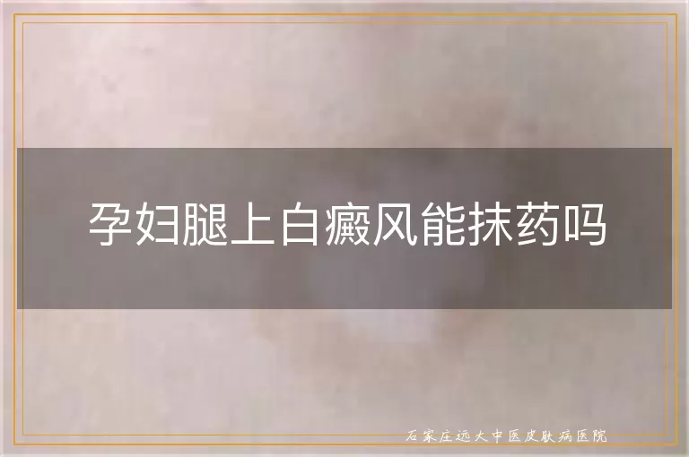 孕妇腿上白癜风能抹药吗