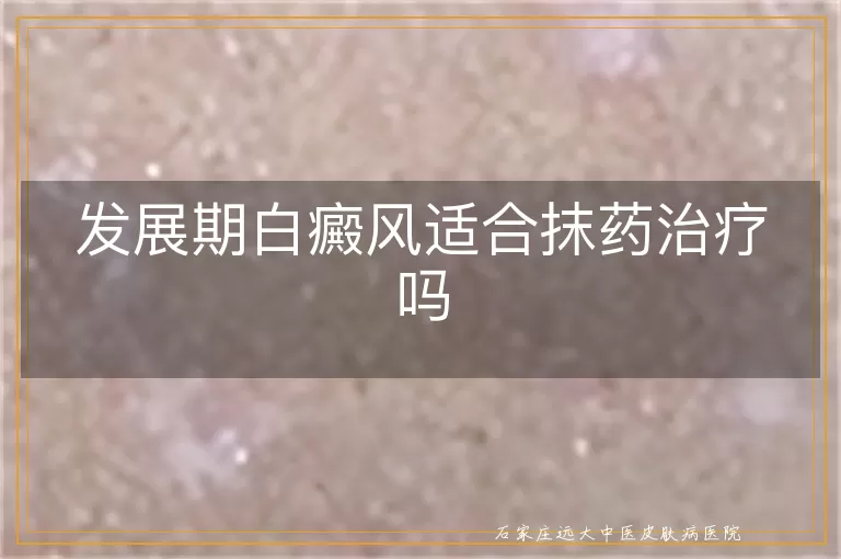 发展期白癜风适合抹药治疗吗