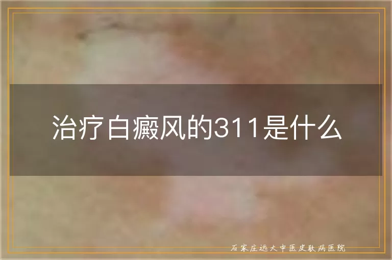 治疗白癜风的311是什么