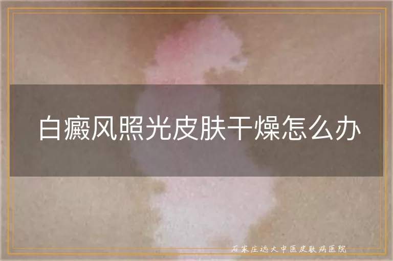 白癜风照光皮肤干燥怎么办