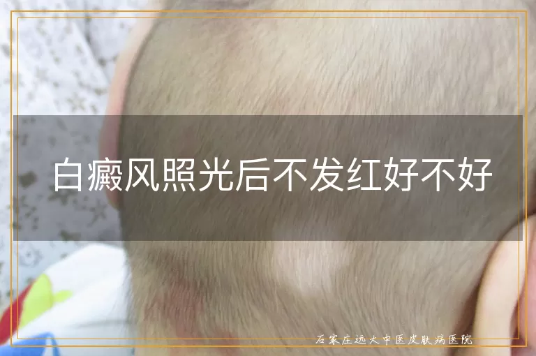 白癜风照光后不发红好不好