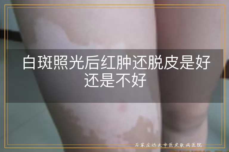 白斑照光后红肿还脱皮是好还是不好