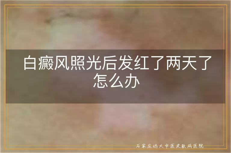 白癜风照光后发红了两天了怎么办