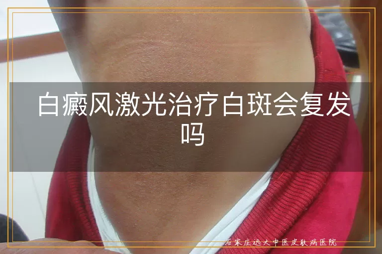 白癜风激光治疗白斑会复发吗