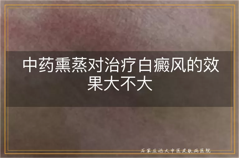 中药熏蒸对治疗白癜风的效果大不大