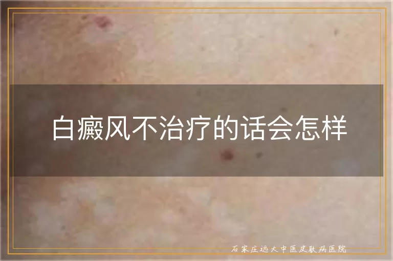 白癜风不治疗的话会怎样