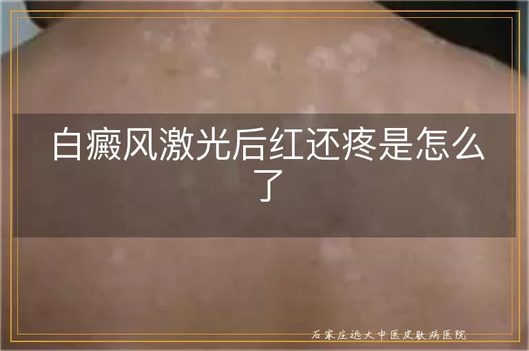 白癜风激光后红还疼是怎么了