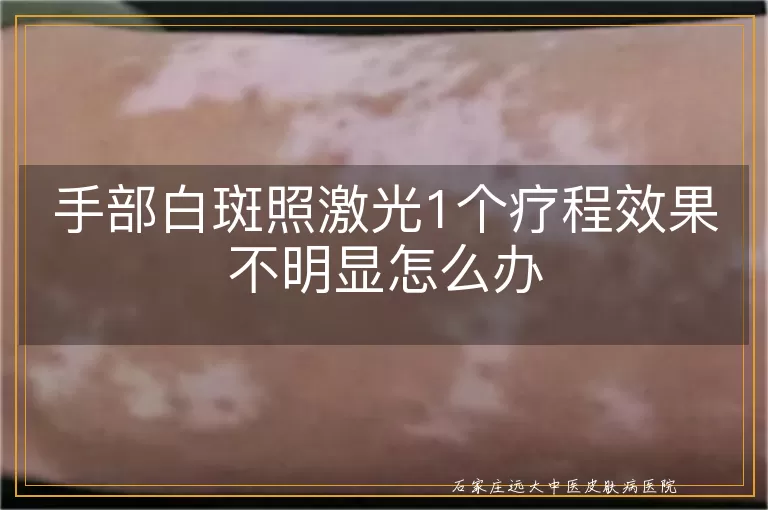手部白斑照激光1个疗程效果不明显怎么办
