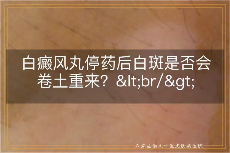 白癜风丸停药后白斑是否会卷土重来？<br/>
