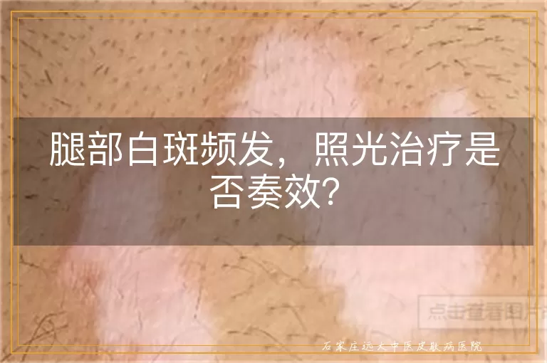 腿部白斑频发，照光治疗是否奏效？