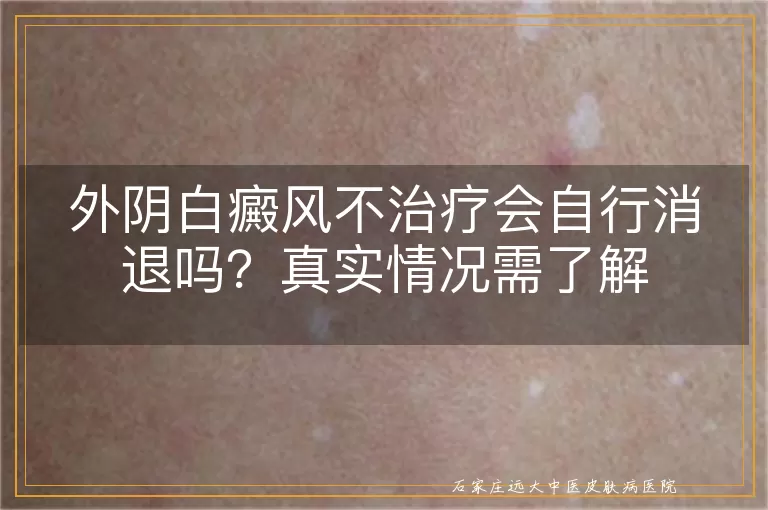 外阴白癜风不治疗会自行消退吗？真实情况需了解