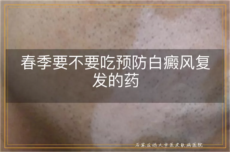 春季要不要吃预防白癜风复发的药