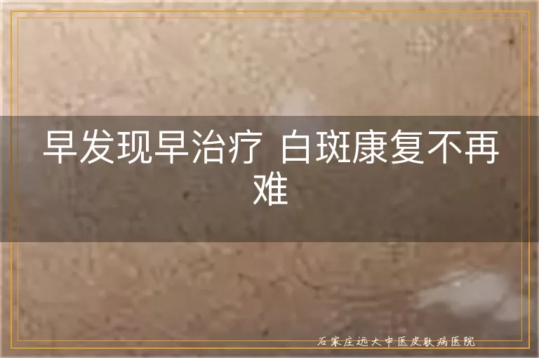 早发现早治疗 白斑康复不再难