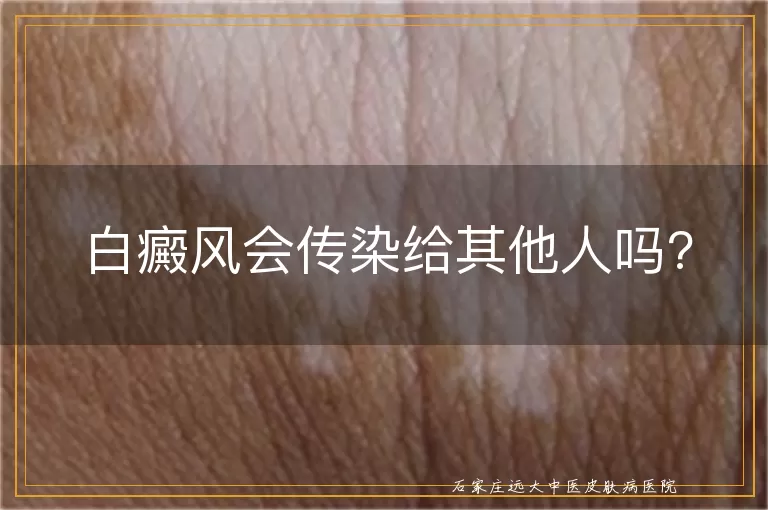 白癜风会传染给其他人吗?