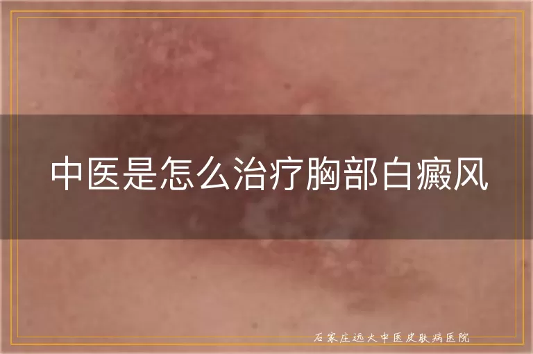 中医是怎么治疗胸部白癜风
