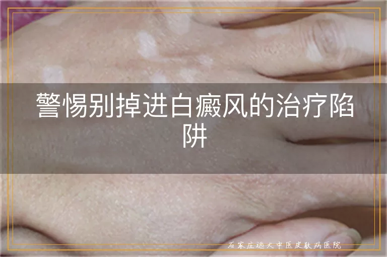 警惕别掉进白癜风的治疗陷阱