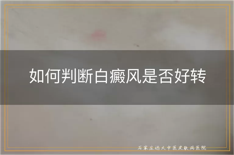 如何判断白癜风是否好转