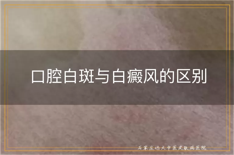 口腔白斑与白癜风的区别