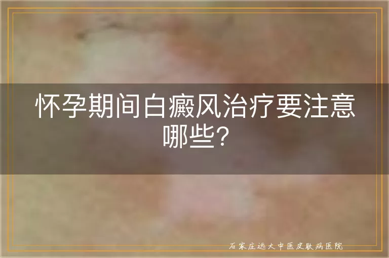 怀孕期间白癜风治疗要注意哪些?