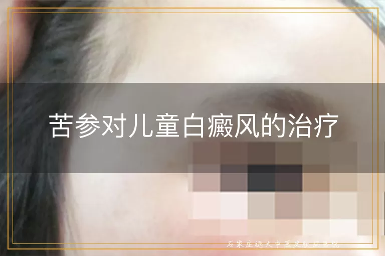 苦参对儿童白癜风的治疗