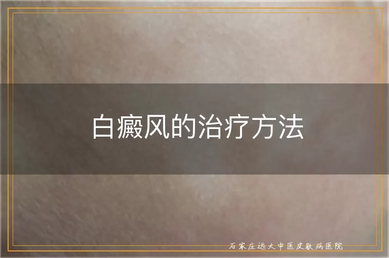 白癜风的治疗方法