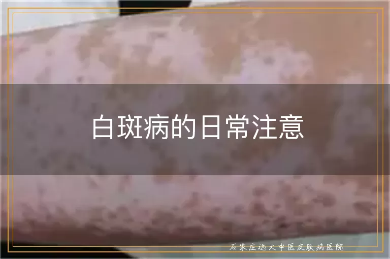 白斑病的日常注意