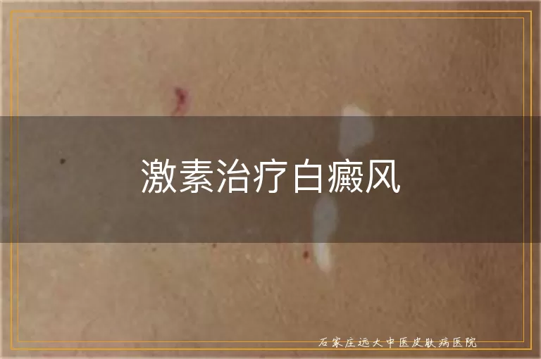 激素治疗白癜风