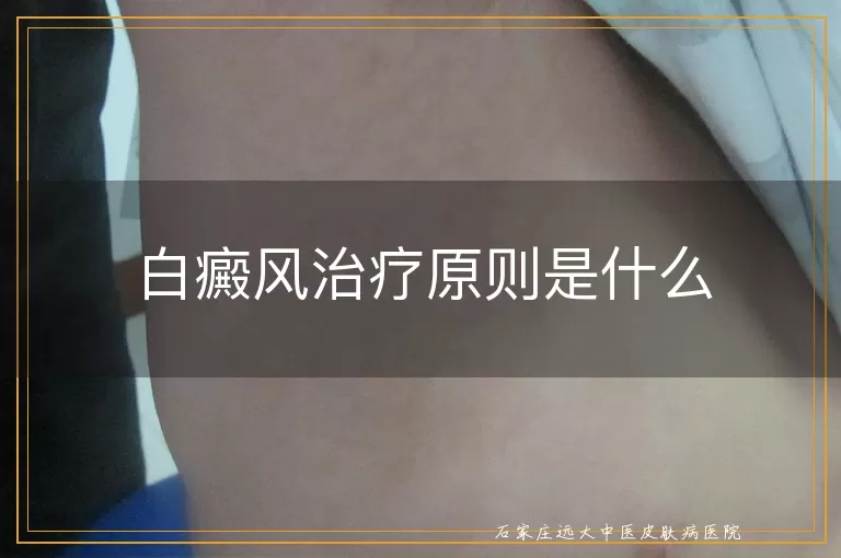 白癜风治疗原则是什么