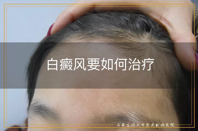 白癜风要如何治疗