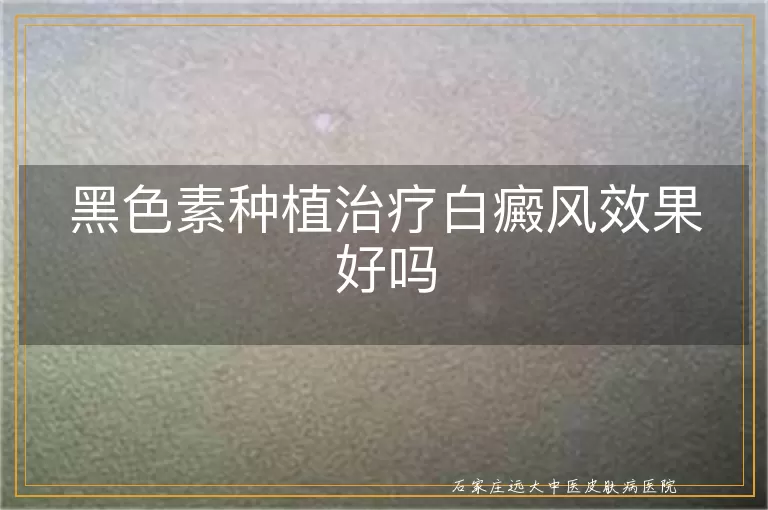 黑色素种植治疗白癜风效果好吗
