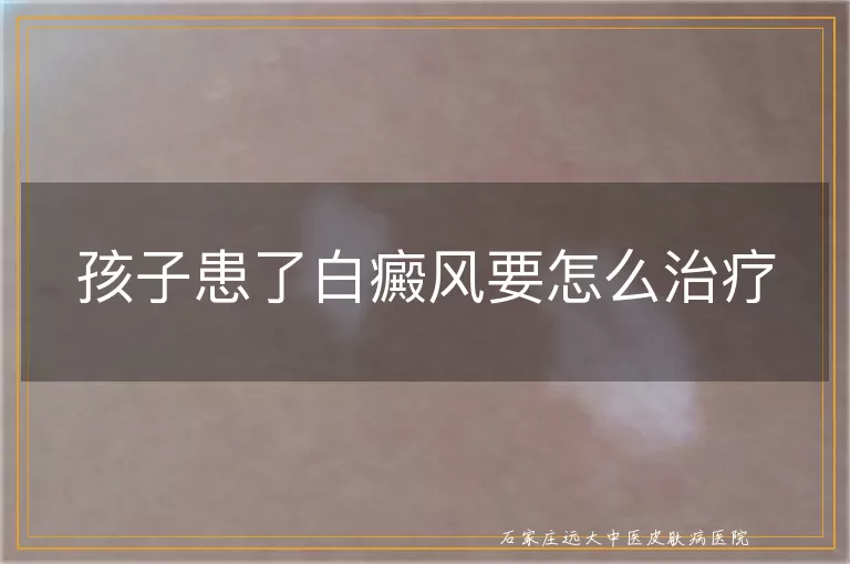 孩子患了白癜风要怎么治疗