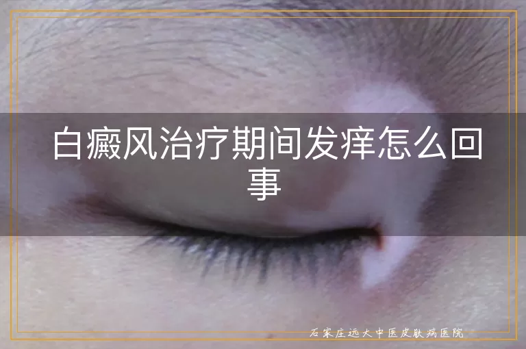 白癜风治疗期间发痒怎么回事