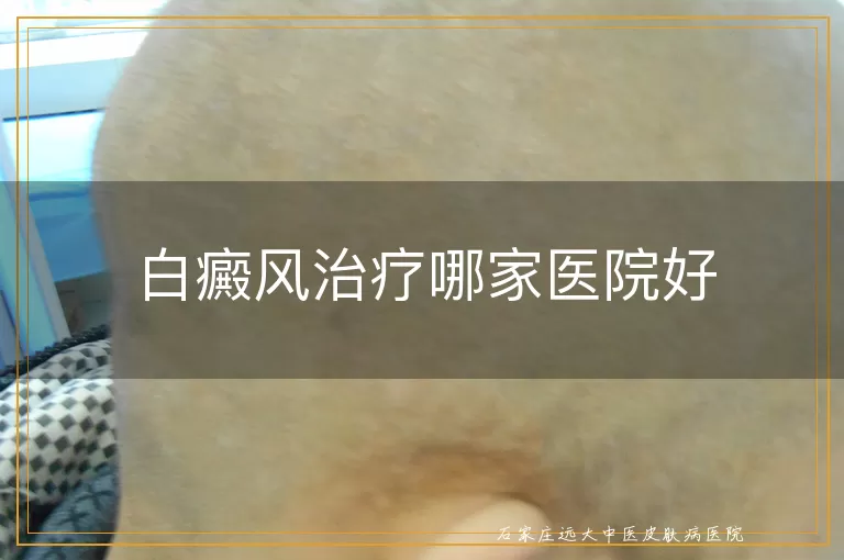 白癜风治疗哪家医院好