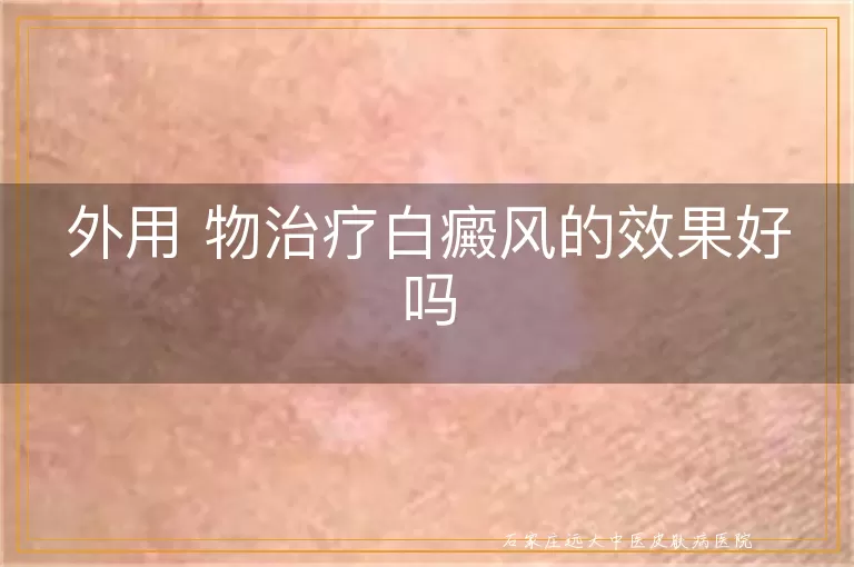 外用 物治疗白癜风的效果好吗