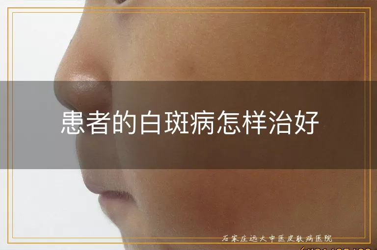 患者的白斑病怎样治好