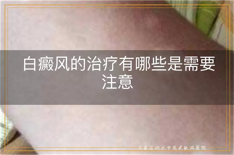 白癜风的治疗有哪些是需要注意