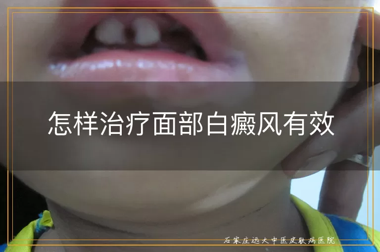 怎样治疗面部白癜风有效