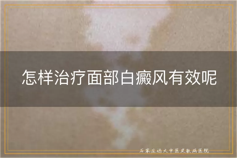怎样治疗面部白癜风有效呢